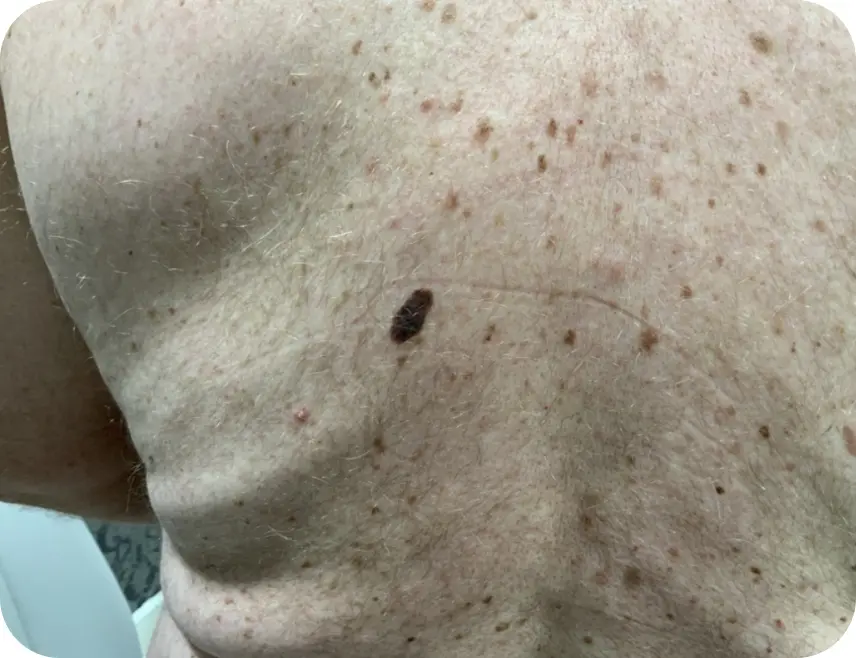 Close-up of a melanoma lesion on a patient’s back.