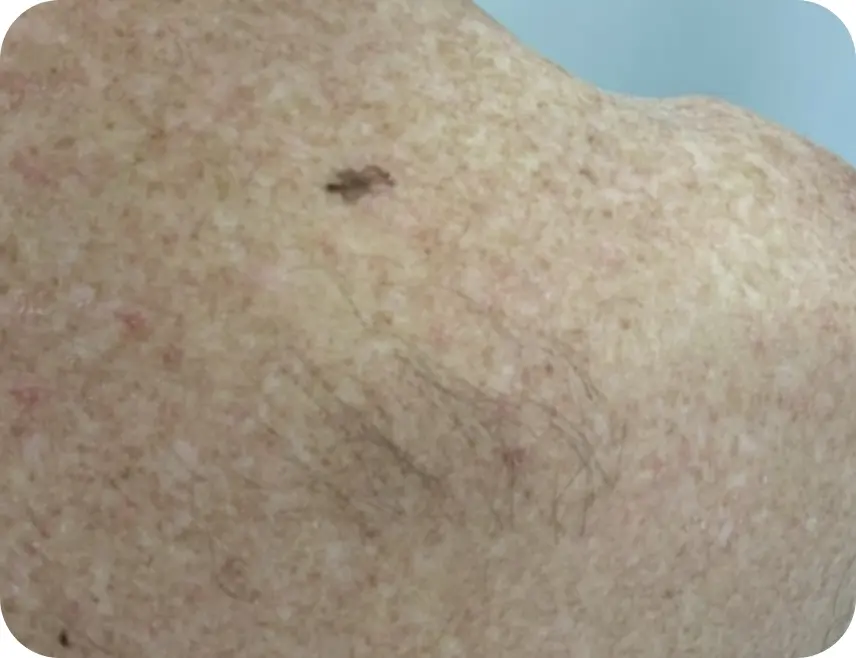 Close-up of a suspicious melanoma lesion on a patient’s skin.