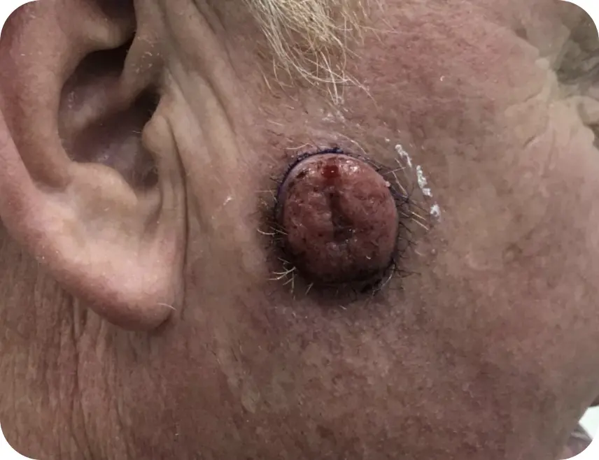 Close-up of a raised skin lesion near the ear.
